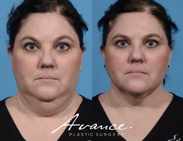 Before and After - Neck Liposuction with FaceTite Radiofrequency