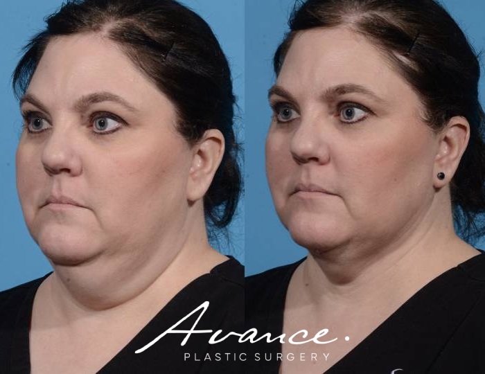 Before and After - Neck Liposuction with FaceTite Radiofrequency
