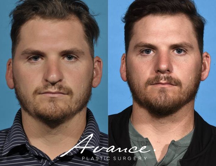 Before and After - Rhinoplasty
