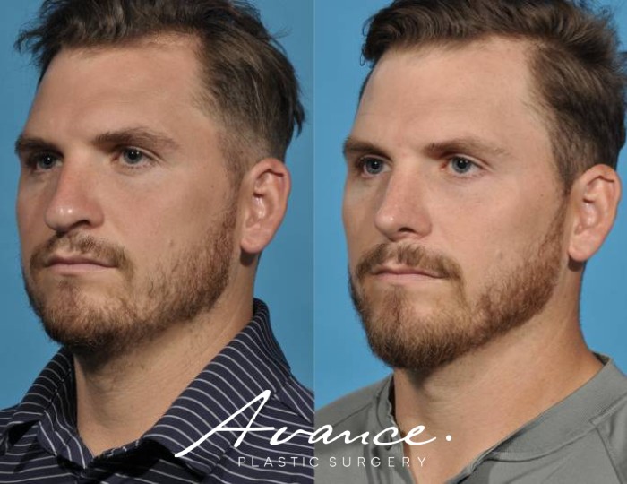 Before and After - Rhinoplasty