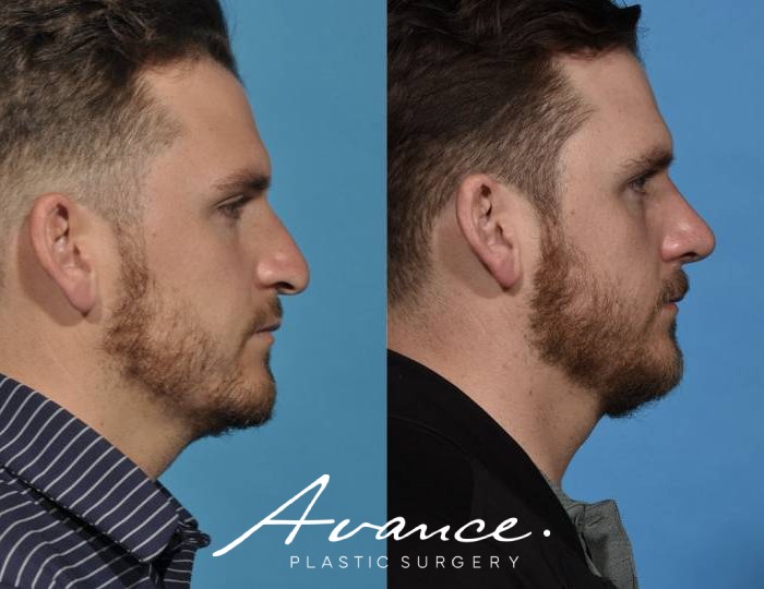 Before and After - Rhinoplasty