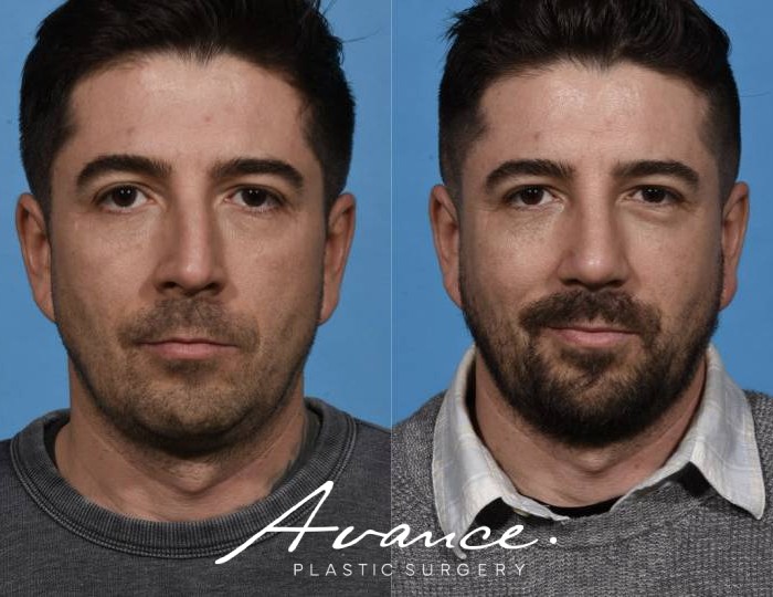 Before and After - Rhinoplasty