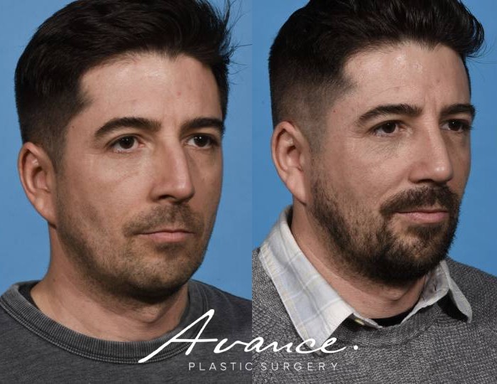 Before and After - Rhinoplasty