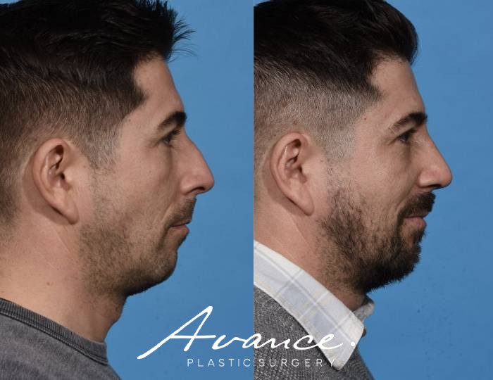 Before and After - Rhinoplasty