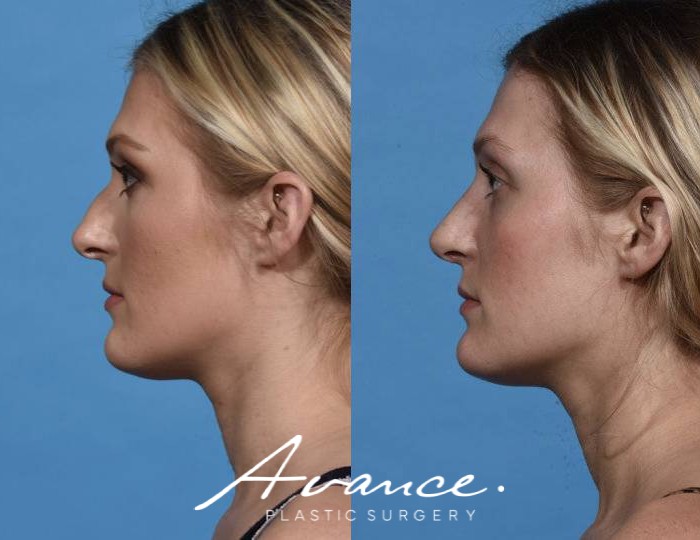 Before and After - Rhinoplasty