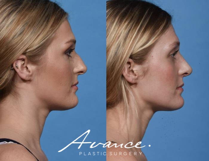 Before and After - Rhinoplasty