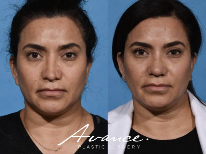 Before and After - Rhinoplasty