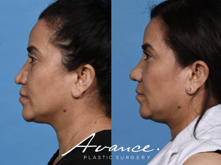 Before and After - Rhinoplasty
