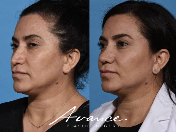 Before and After - Rhinoplasty