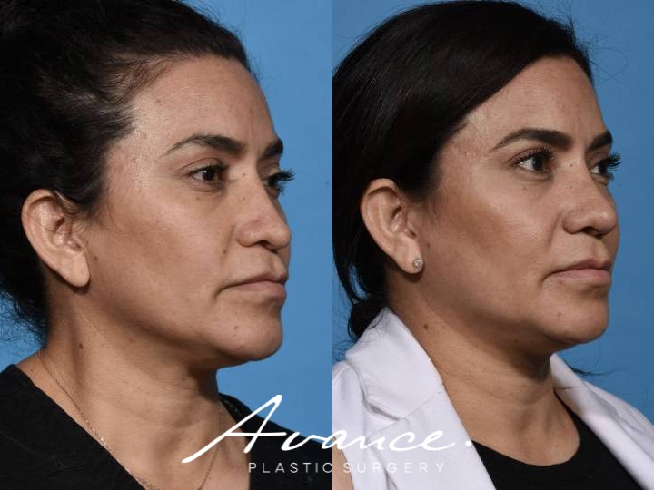 Before and After - Rhinoplasty