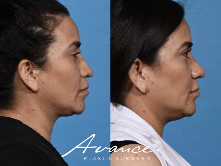 Before and After - Rhinoplasty