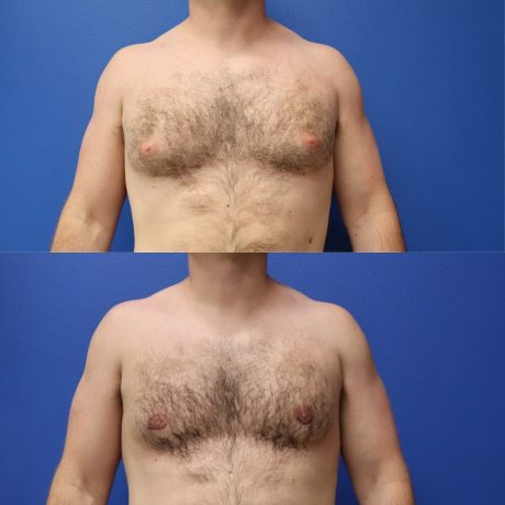 Before and After - Gynecomastia (Male Breast Reduction)