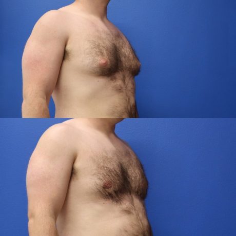 Before and After - Gynecomastia (Male Breast Reduction)