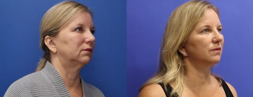 Before and After - Face & Neck