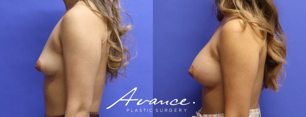 Before and After - Breast Augmentation