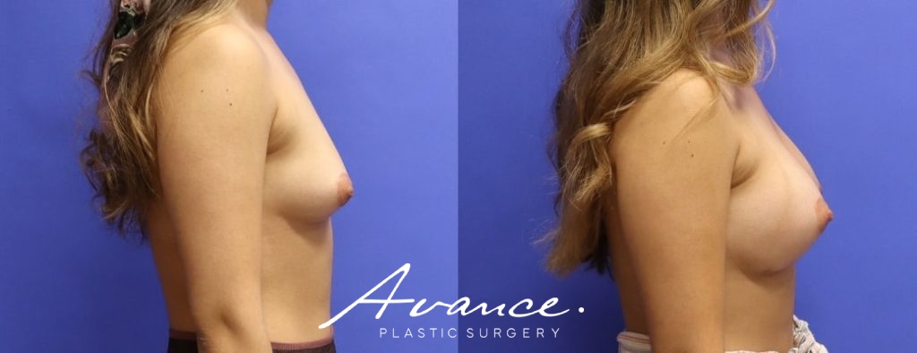 Before and After - Breast Augmentation