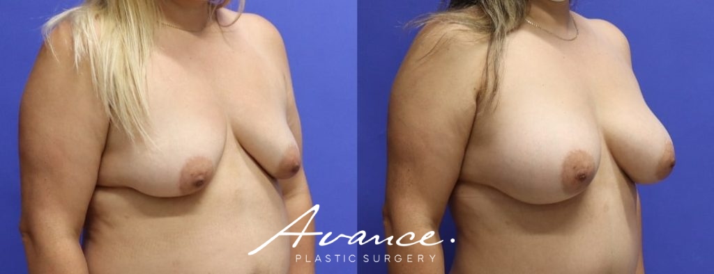 Before and After - Breast Augmentation