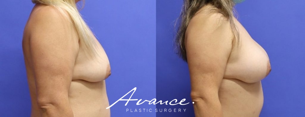 Before and After - Breast Augmentation