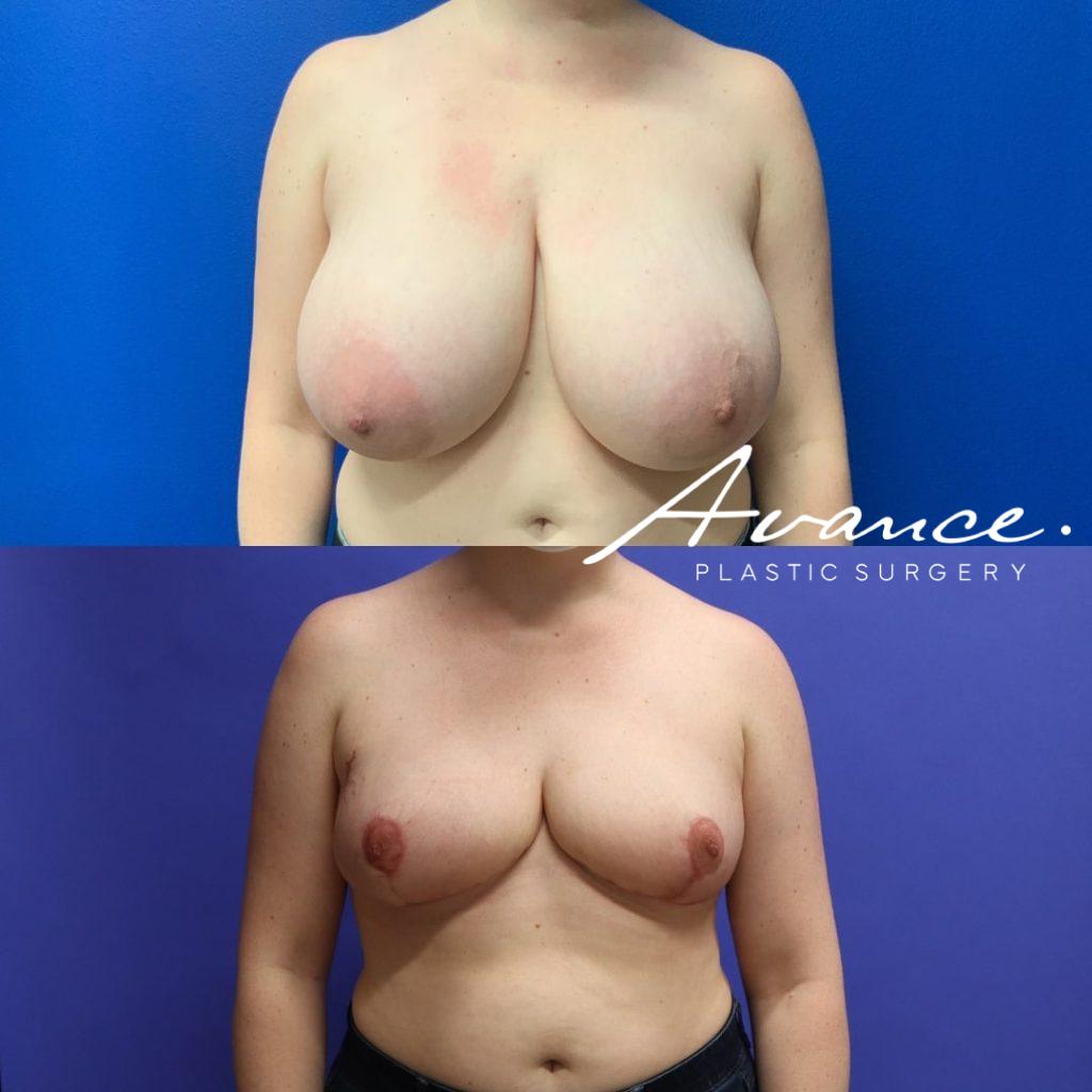 Before and After - Breast Reduction