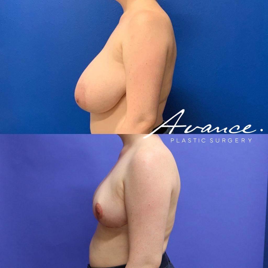 Before and After - Breast Reduction