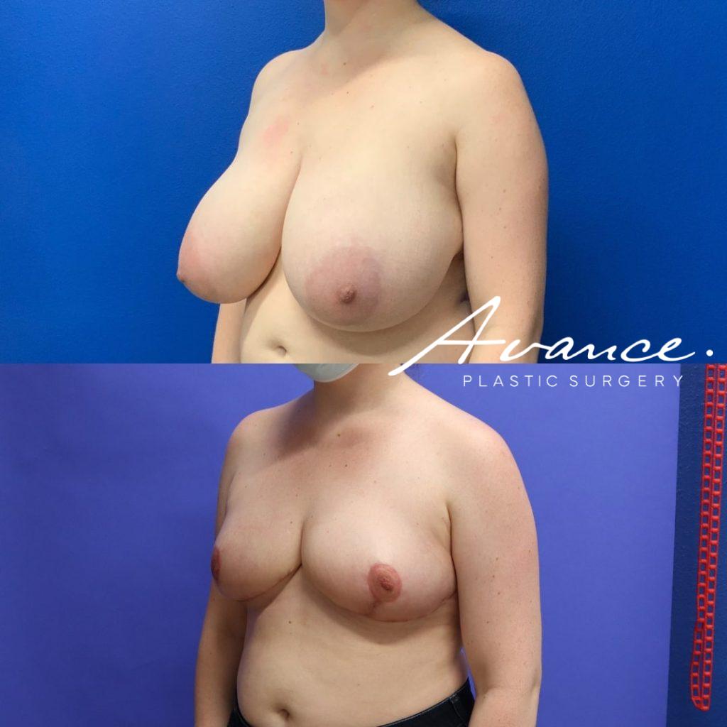 Before and After - Breast Reduction