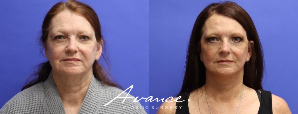 Before and After - Mini Face/Necklift