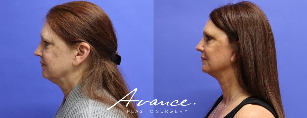 Before and After - Mini Face/Necklift