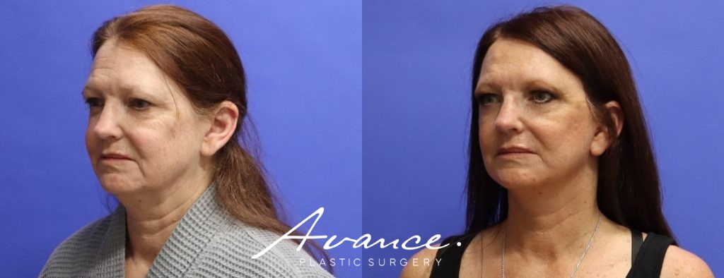 Before and After - Mini Face/Necklift