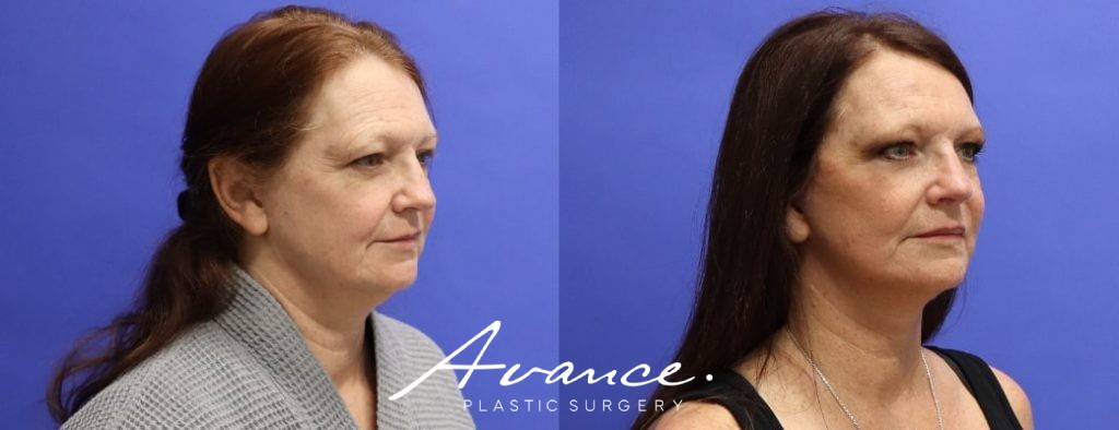 Before and After - Mini Face/Necklift