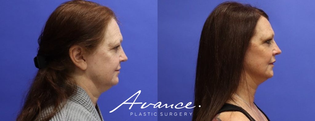 Before and After - Mini Face/Necklift