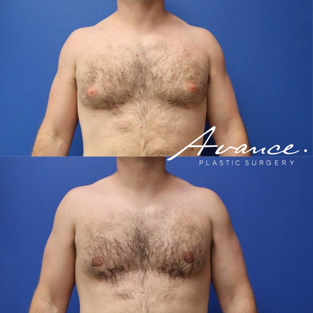 Before and After - Gynecomastia (Male Breast Reduction)