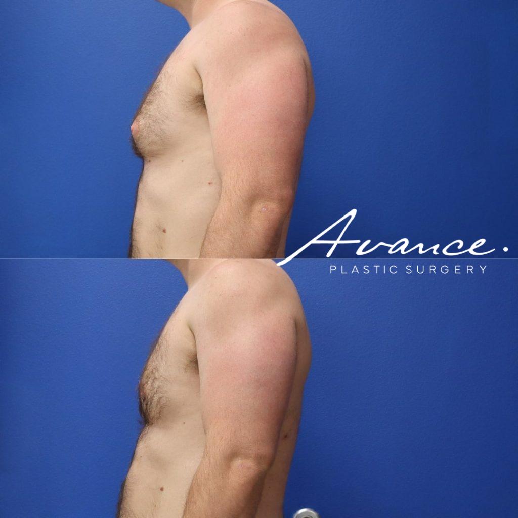 Before and After - Gynecomastia (Male Breast Reduction)