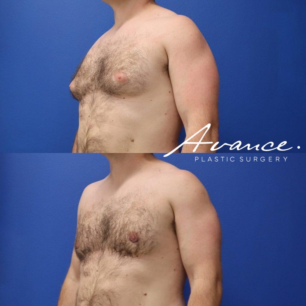 Before and After - Gynecomastia (Male Breast Reduction)