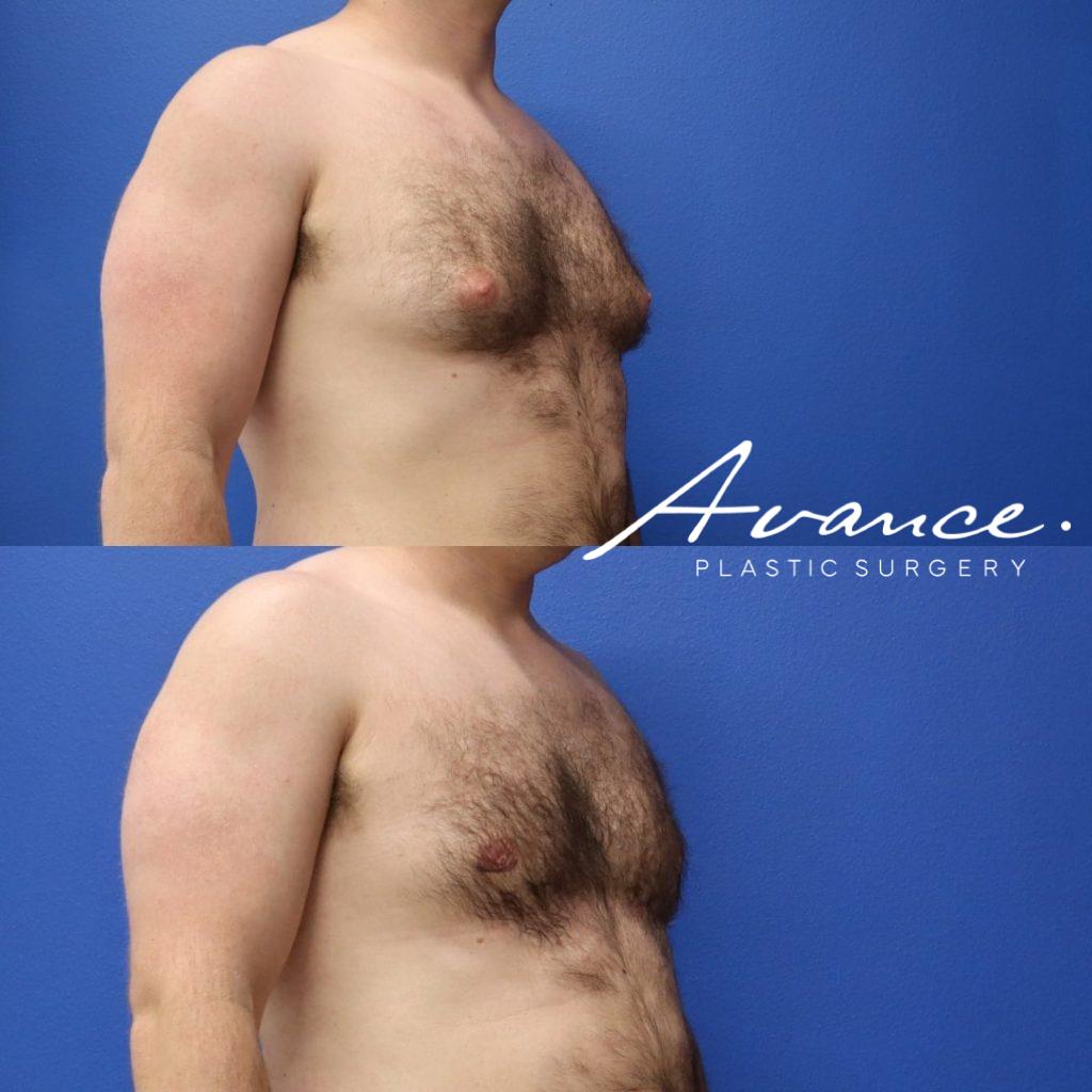 Before and After - Gynecomastia (Male Breast Reduction)