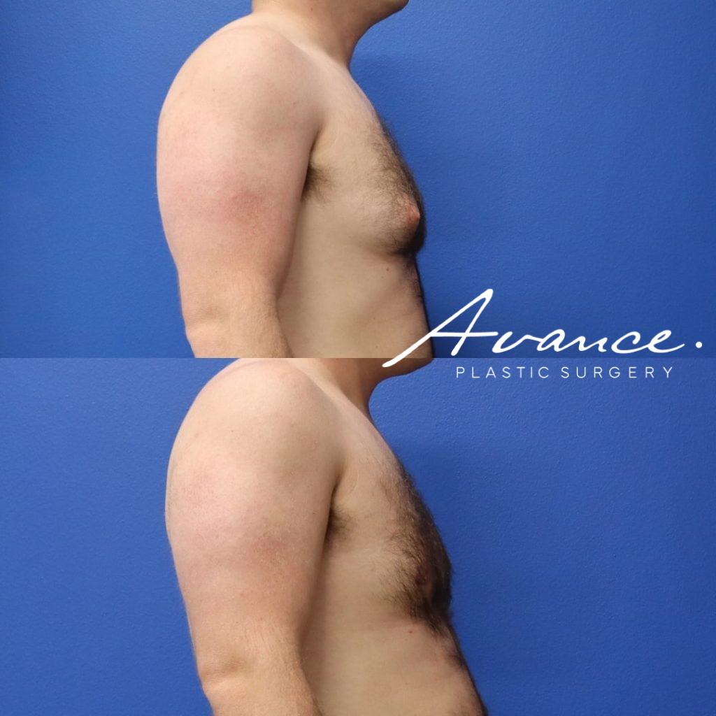 Before and After - Gynecomastia (Male Breast Reduction)
