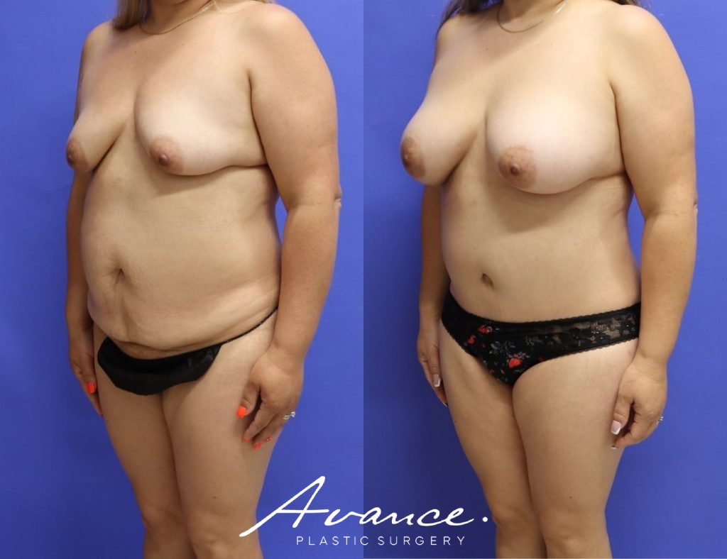 Before and After - Cambio de imagen para mamás