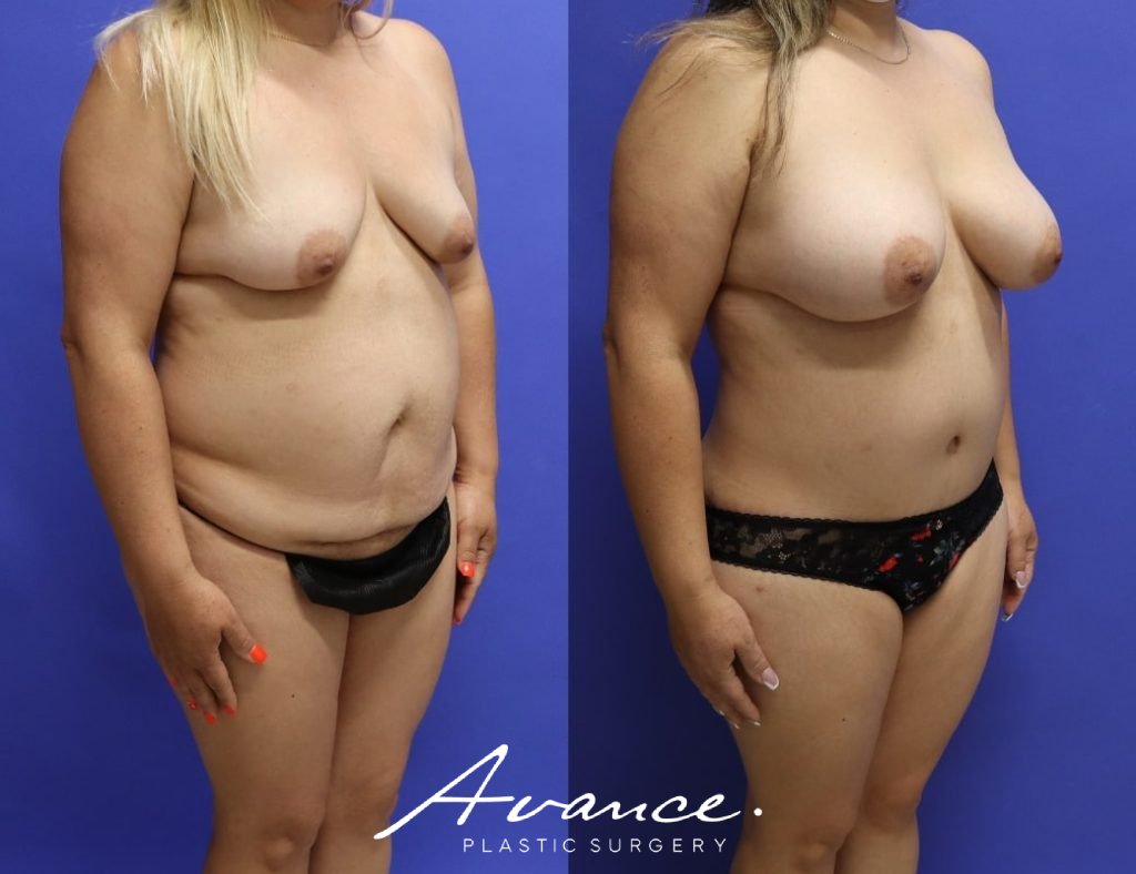 Before and After - Cambio de imagen para mamás
