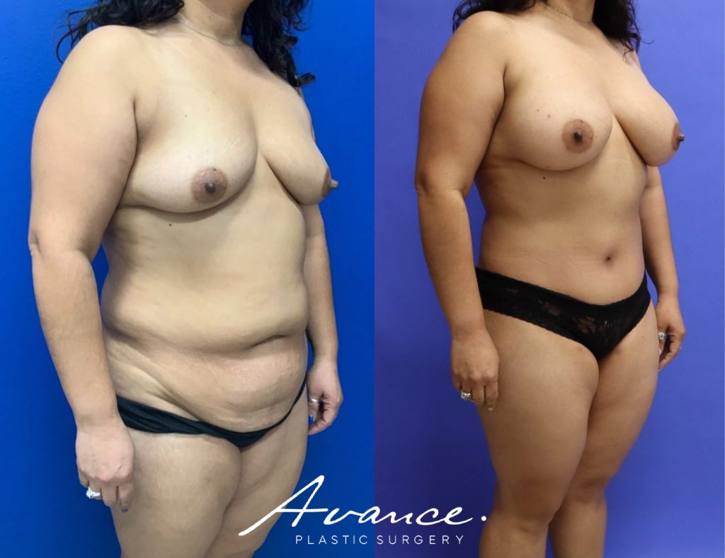 Before and After - Cambio de imagen para mamás