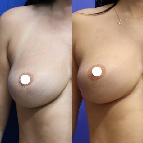Before and After - Fat Transfer to Breast