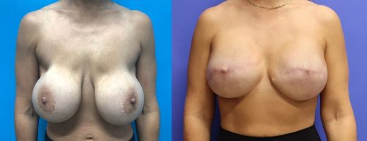 Before and After - Breast Reconstruction