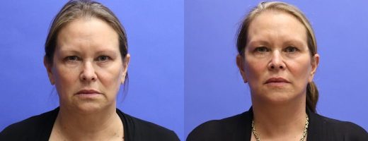 Before and After - Face
