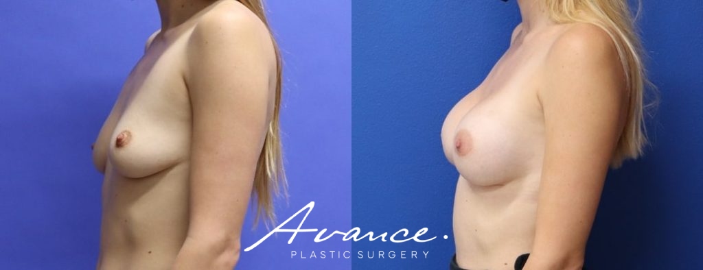 Before and After - Breast Augmentation