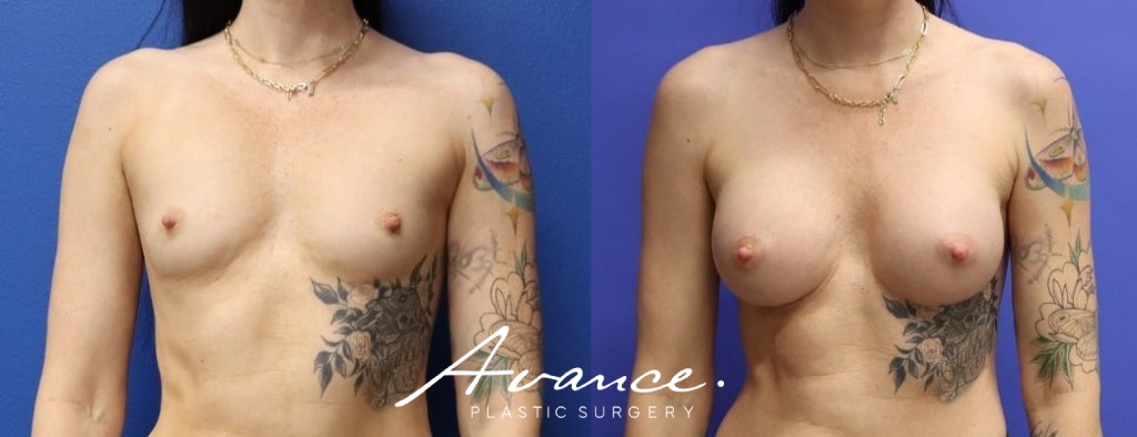 Before and After - Breast Augmentation