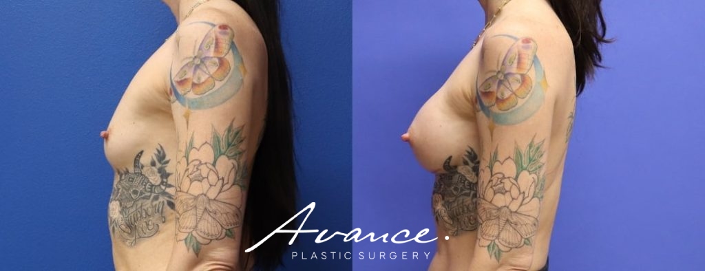Before and After - Breast Augmentation