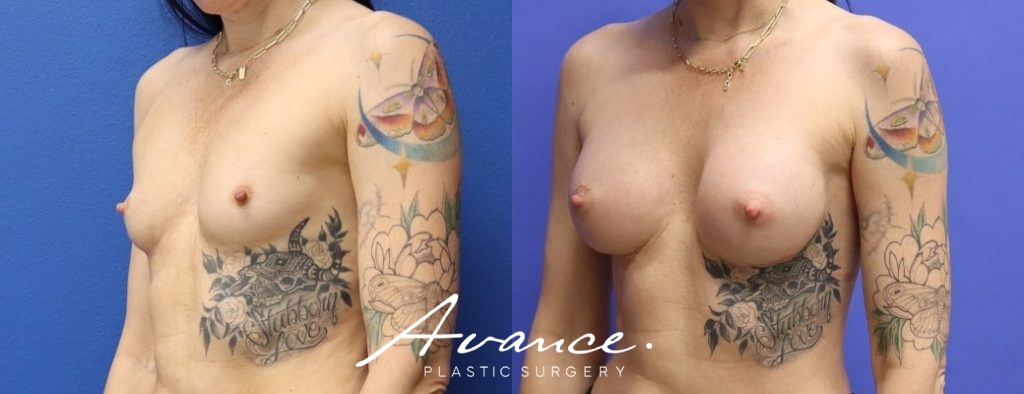 Before and After - Breast Augmentation