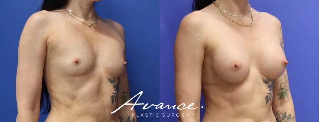 Before and After - Breast Augmentation