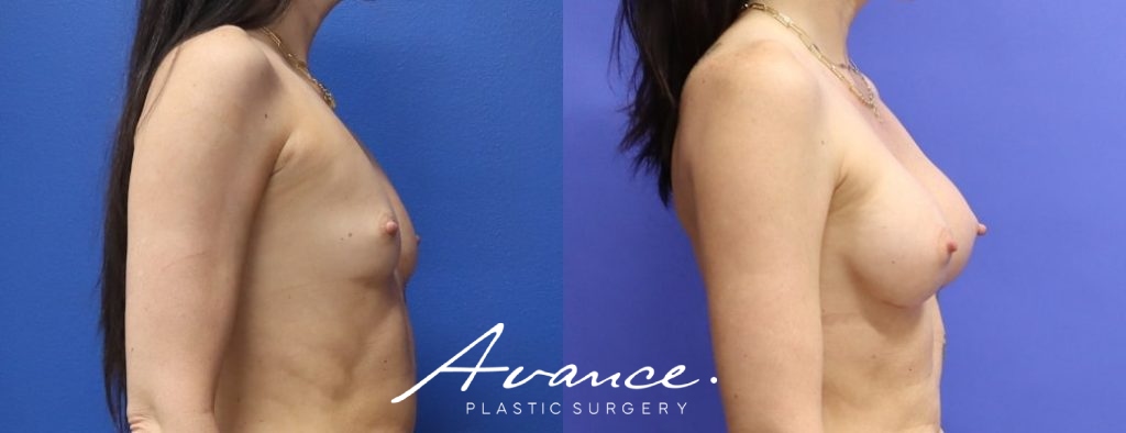 Before and After - Breast Augmentation