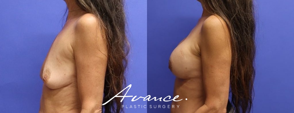 Before and After - Breast Augmentation