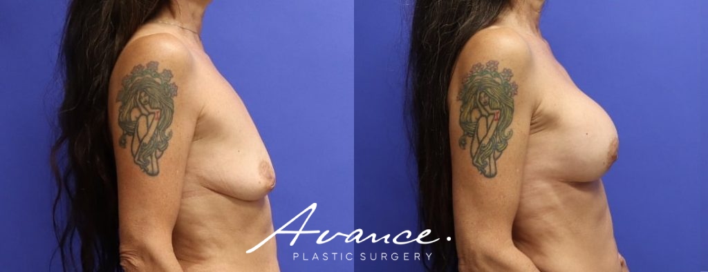 Before and After - Breast Augmentation