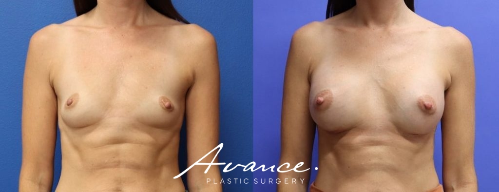 Before and After - Breast Augmentation